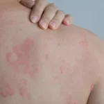 Allergy Symptoms