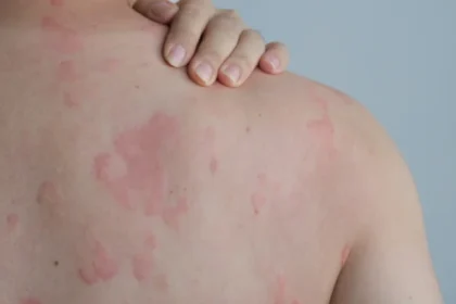 Allergy Symptoms