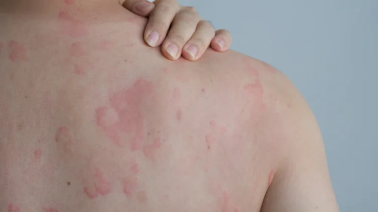 Allergy Symptoms