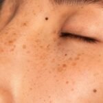 Managing Hyperpigmentation and UV Protection in Equatorial Climates