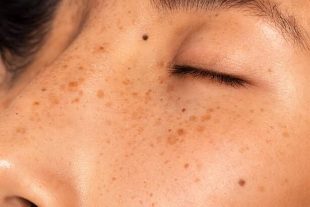 Managing Hyperpigmentation and UV Protection in Equatorial Climates
