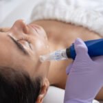 Benefits of Microneedling for Acne Scars