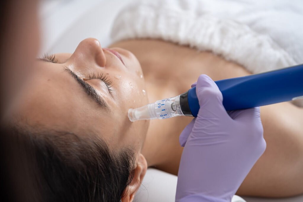 Benefits of Microneedling for Acne Scars
