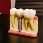 Dental Implants Versus Removables