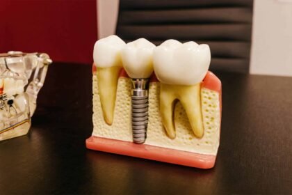 Dental Implants Versus Removables