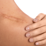 Dermatologists Can Help With Scarring