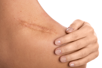 Dermatologists Can Help With Scarring