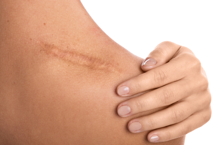 Dermatologists Can Help With Scarring