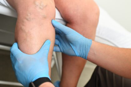 Effective Varicose Vein Treatment Options