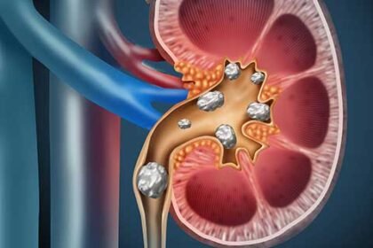Kidney Stones