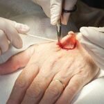 Mohs Surgery Techniques