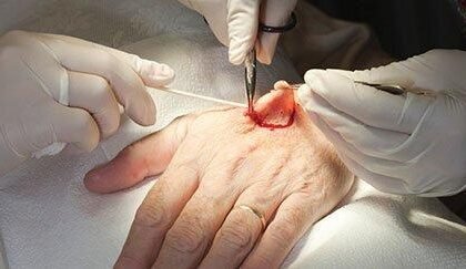 Mohs Surgery Techniques