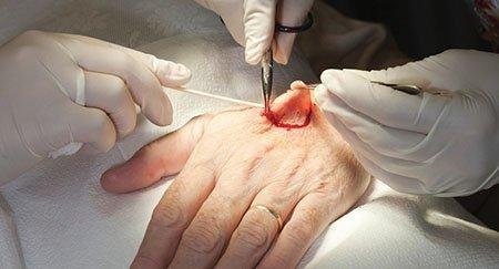 Mohs Surgery Techniques