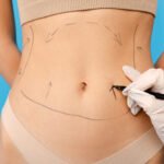 Recovery Process After Liposuction