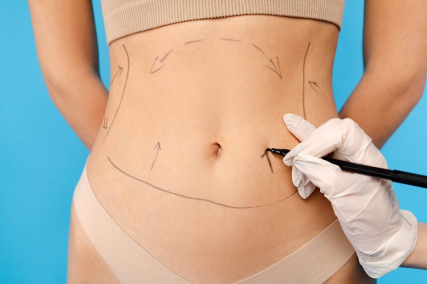 Recovery Process After Liposuction