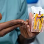 Root Canal