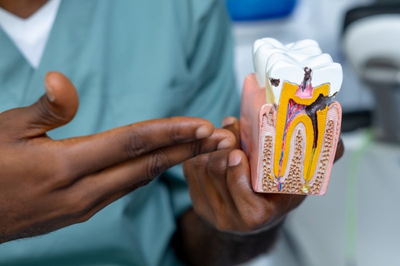 Root Canal