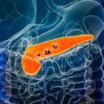 Staging of Pancreatic Cancer