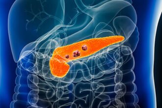Staging of Pancreatic Cancer