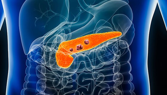 Staging of Pancreatic Cancer