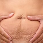 Tummy Tuck