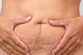 Tummy Tuck