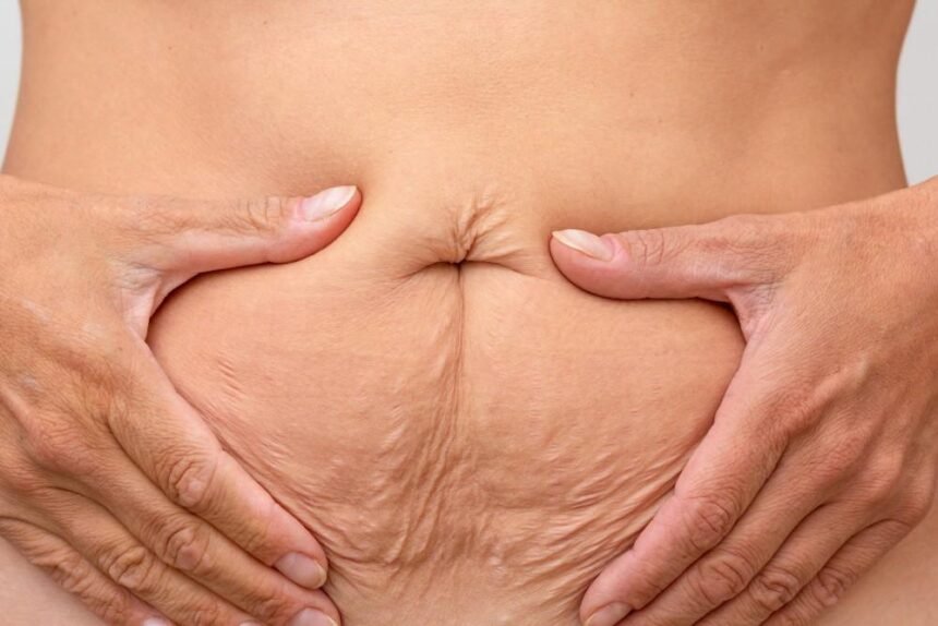 Tummy Tuck